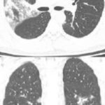 Pneumonia por COVID-19 e Mergulho